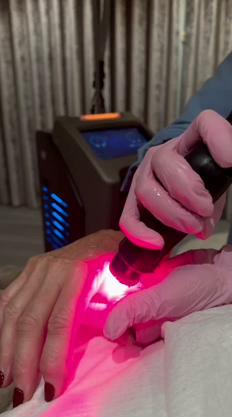 RedTouch PRO Laseranwendung an der Hand bei Aesthetic Concept Kö