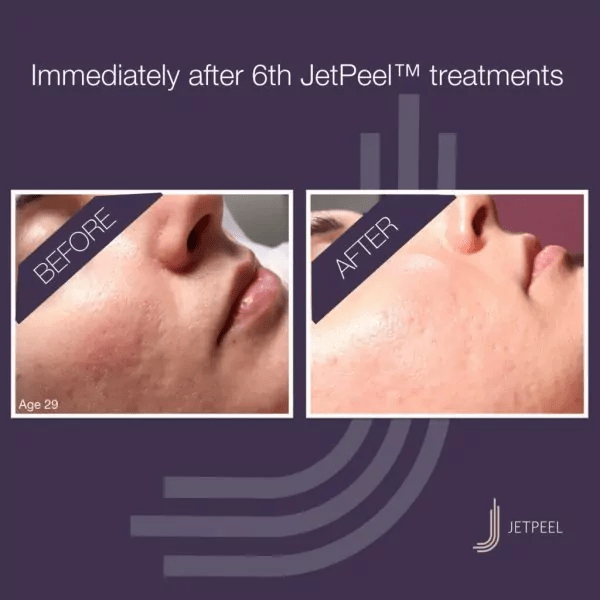 JetPeel