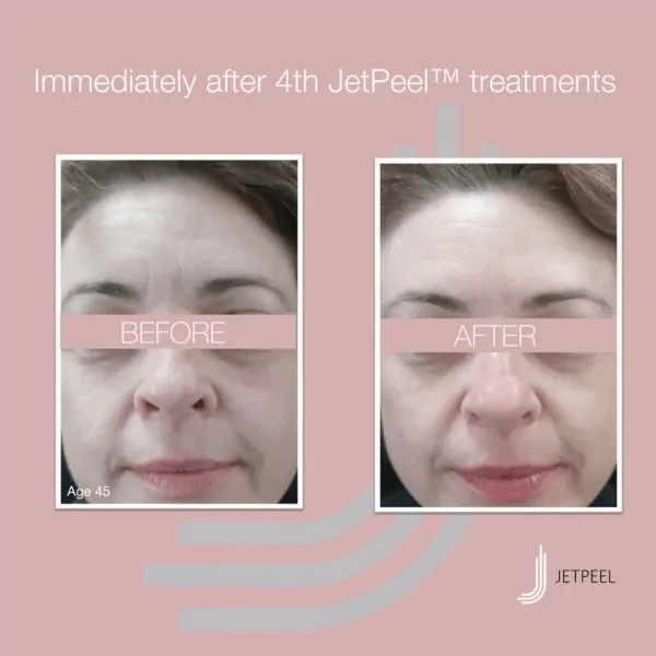 JetPeel