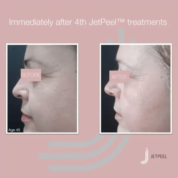 JetPeel